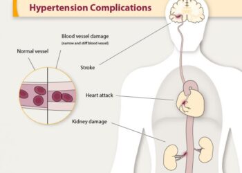 Simak Ancaman Hipertensi dan Cara Mencegahnya!